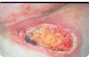 19553_sacral_pressure_ulcer