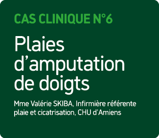 Cas Clinique N°6 Plaies d’amputation de doigts Mme Val rie SKIBA, Infirmi re r f rente plaie et cicatrisation, CHU d’...