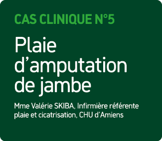 Cas Clinique N°5 Plaie d’amputation de jambe Mme Val rie SKIBA, Infirmi re r f rente plaie et cicatrisation, CHU d’Am...